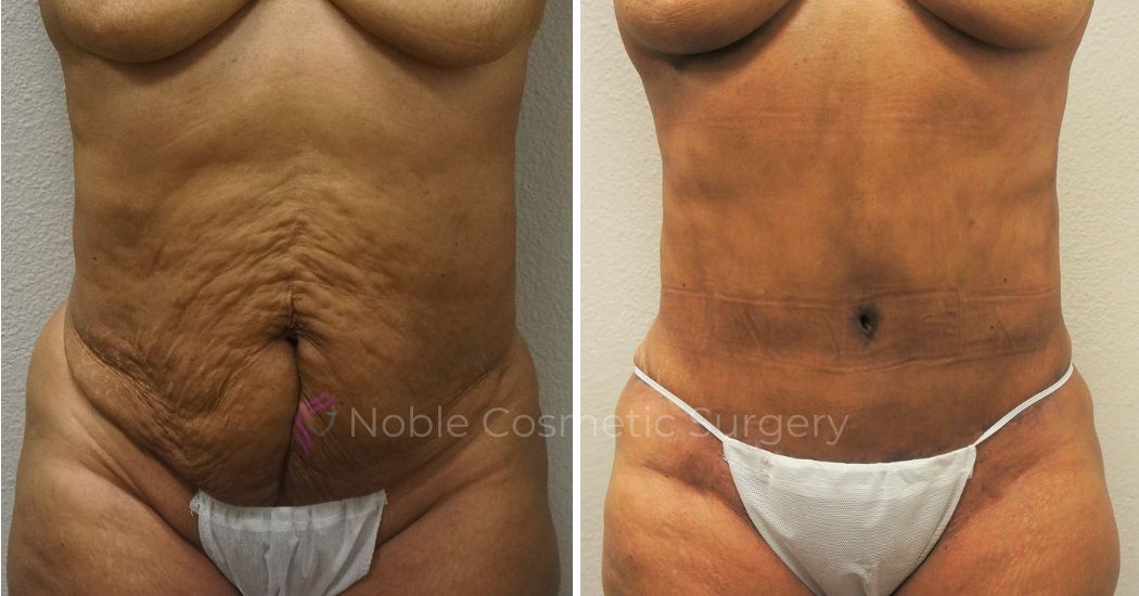 P21-00052A | Before and After Abdominoplasty 1