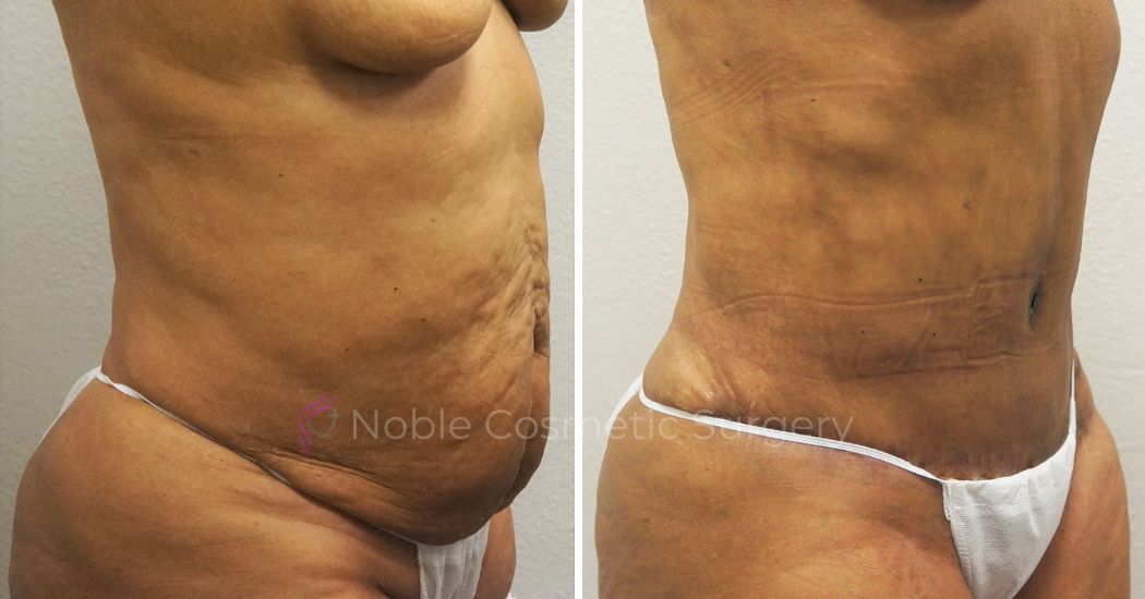 P21-00052A | Before and After Abdominoplasty 2