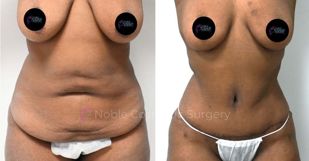 P38-00318A | Before and After Abdominoplasty 1