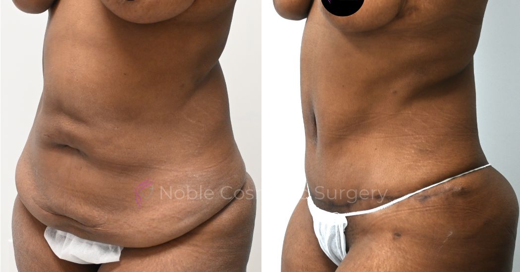 P38-00318A | Before and After Abdominoplasty 2