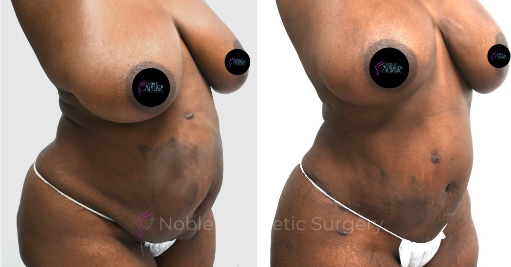 P41-00323A | Before and After Abdominoplasty 2