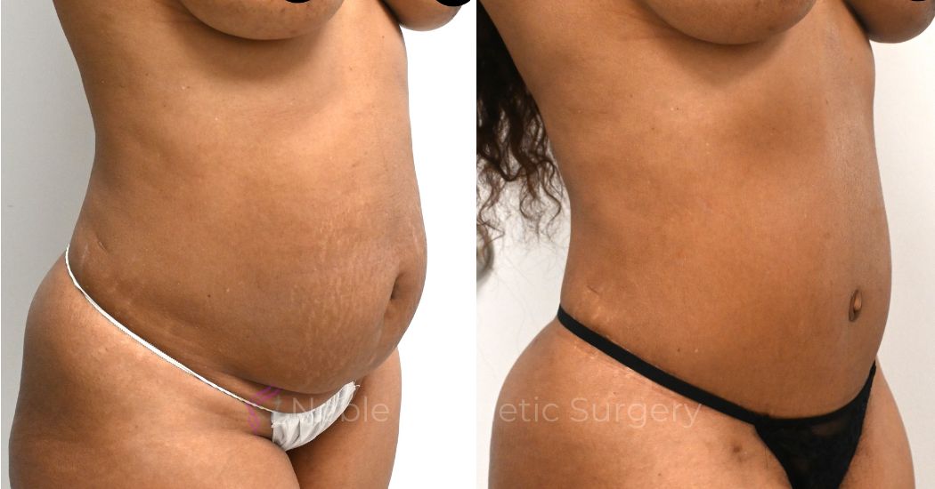 P44-00326A | Before and After Abdominoplasty 2
