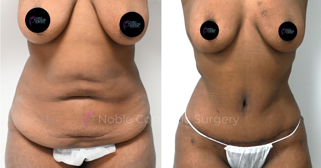 P45-10784A | Before and After Abdominoplasty 1