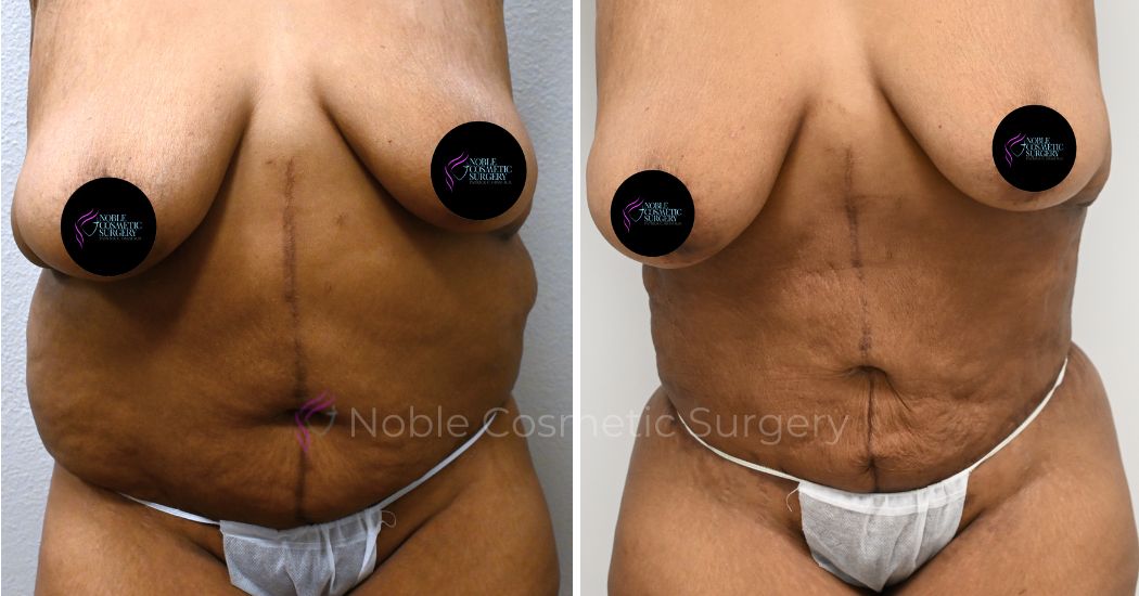 P5-00036A | Before and After Abdominoplasty 1