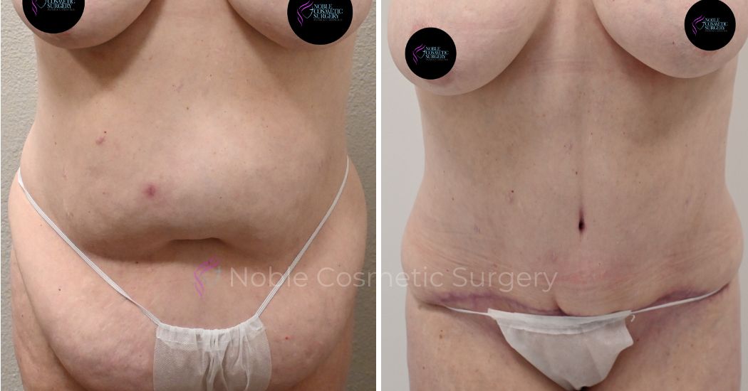 P8-00039A | Before and After Abdominoplasty 1