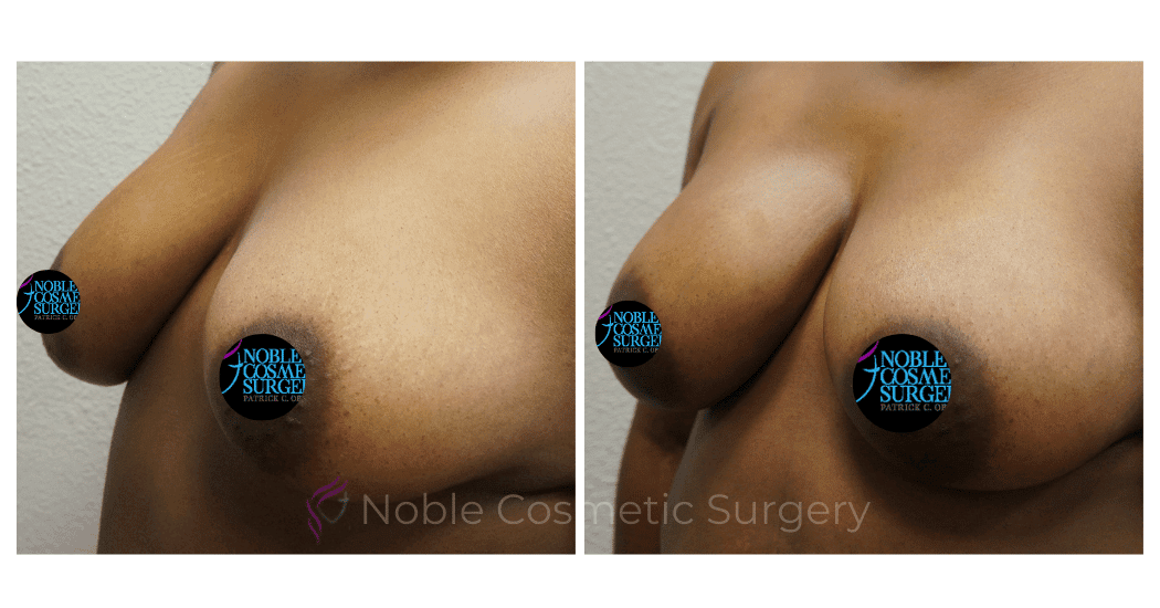 BREAST-AUGMENTATION-WITH-FAT-TRANSFER-CASE-00266 | Before and After Breast Augmentation 1