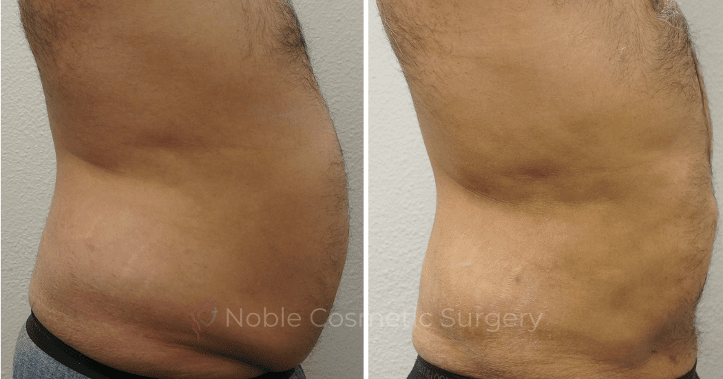 LIPOSUCTION-ABDOMEN-CASE-00600 | Before and After Men