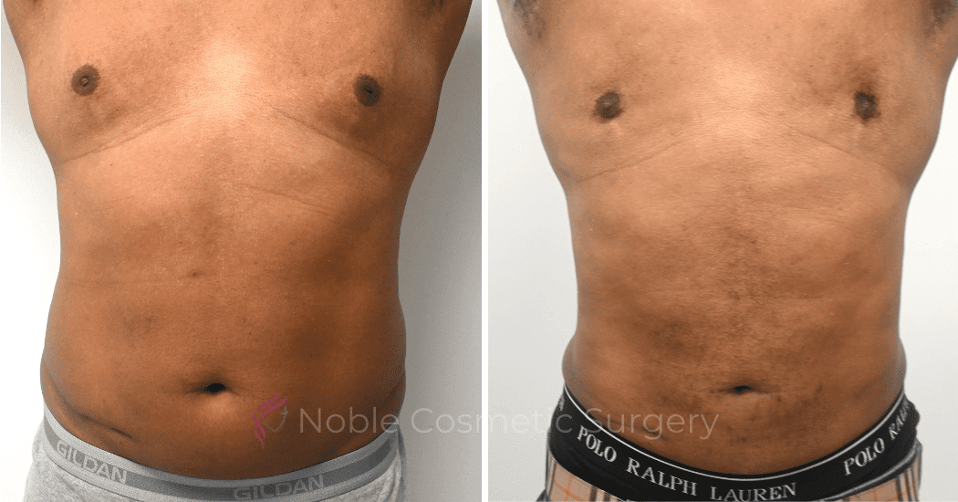 GYNECOMASTIA-CASE-10270 | Before and After Men