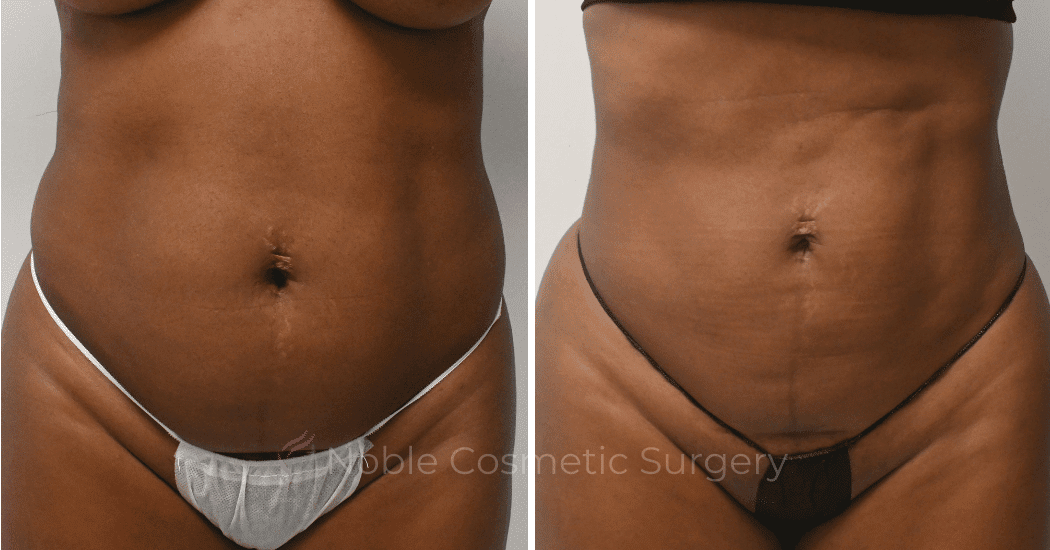LIPOSUCTION-CASE-10510 | Before and After Liposuction 1