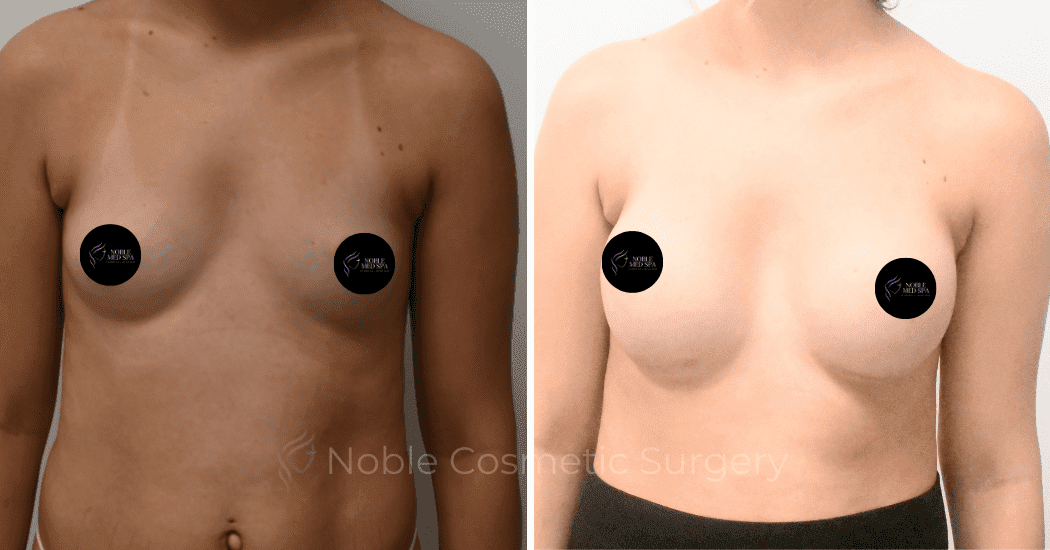 BREAST-AUGMENTATION-CASE-11094 | Before and After Breast