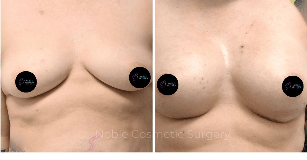 BREAST-AUGMENTATION-CASE-11771 | Before and After Breast
