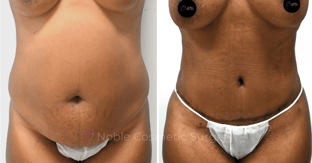 TUMMY-TUCK-CASE-12002 | Before and After Body