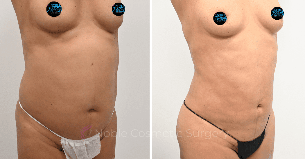 LIPOSUCTION-ABDOMEN-CASE-12162 | Before and After Body