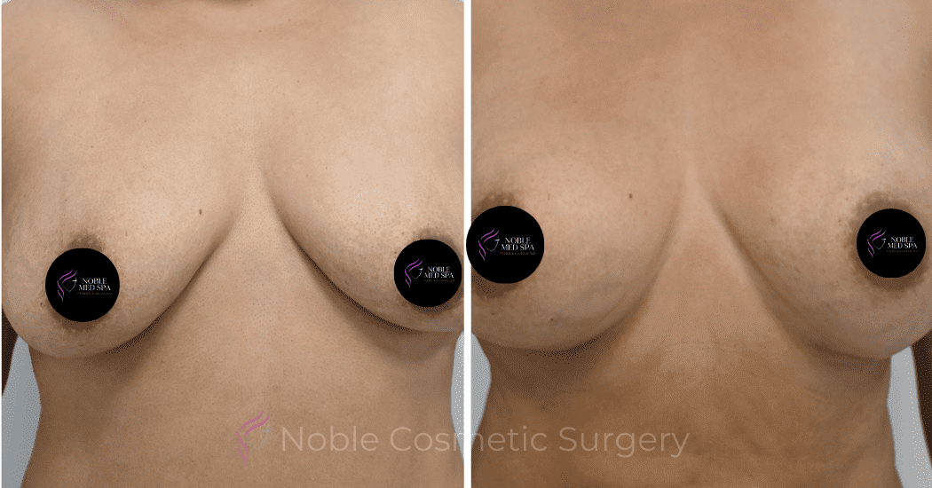 BREAST-AUGMENTATION-CASE-12466 | Before and After Breast