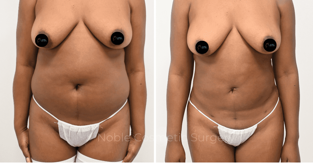 LIPOSUCTION-CASE-12998 | Before and After Liposuction 1