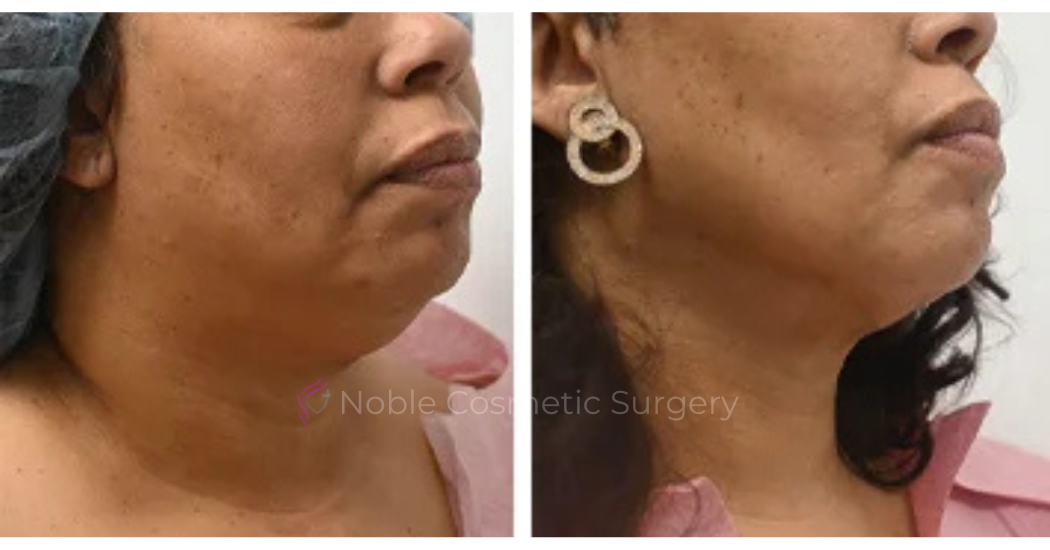 SUBMENTAL-LIPOSUCTION--CHIN--CASE-19224 | Before and After Face