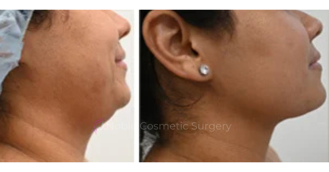 SUBMENTAL-LIPOSUCTION--CHIN--CASE-19225 | Before and After Face