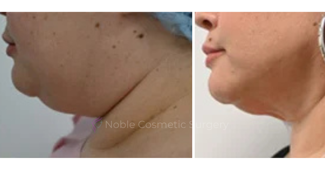 SUBMENTAL-LIPOSUCTION--CHIN--CASE-19226 | Before and After Face